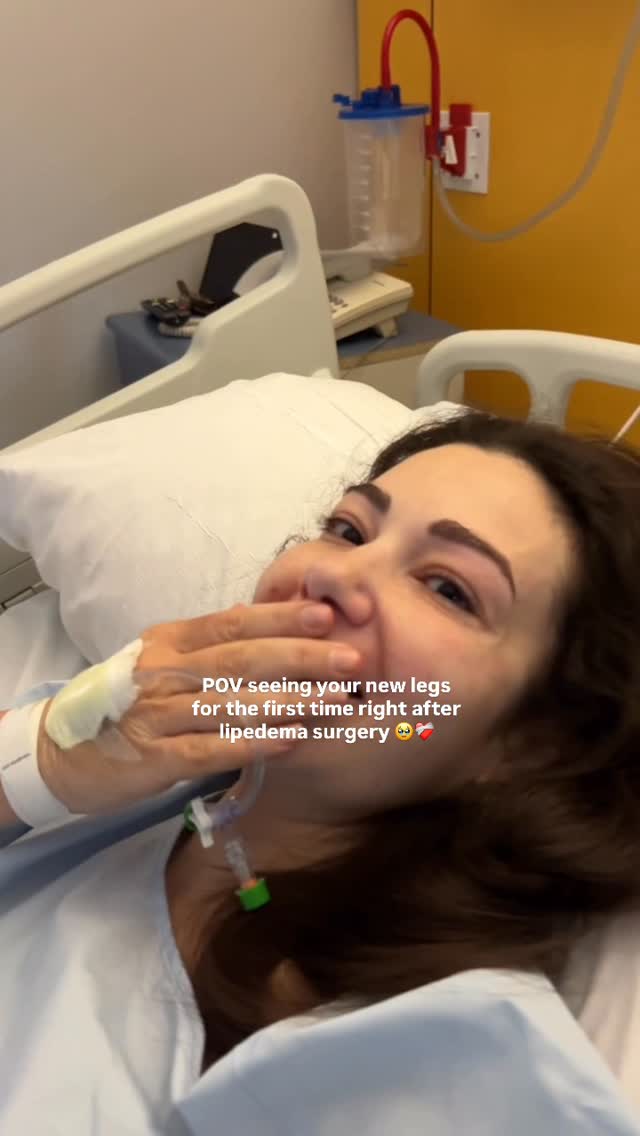 seeing my new legs for the first time after lipedema surgery, my real reaction 😭 this is honestly so emotional for me to look back on, besides the fact that I was still loopy from the anaesthetic and pain meds, I just couldn’t believe those legs were really mine. feels vulnerable to share but I’m so glad I captured these raw moments as they were happening ❤️‍🩹 exactly 2 weeks post-op today! My lipedema surgery was with the incredible Lipemedical team in Madrid. So thankful to be under the care of such a compassionate and talented team @drburgosdelaobra_lipedema 🏥#lipedema #lipoedema #lipedemasurgery by @miss___jones