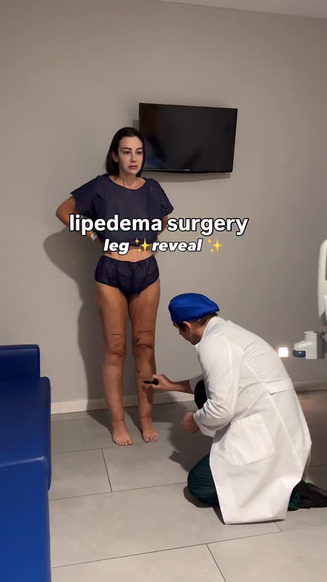 I did it 🥹🙌🏼 A lifetime of wondering what’s “wrong” with my legs, of pain, of swelling, of wondering why I looked so different to all of my friends. A lifetime of knowing something isn’t quite right but being told you’re just “not doing enough”. A lifetime of pain, heaviness, unexplained bruising and puffy ankles. I know my fellow lipedema warriors will relate to all of these feelings. After having lost over 75kg in an attempt to mitigate my lipedema, completely changing my entire diet and lifestyle habits in the process, the stage 2 lipedema in my lower legs simply wouldn’t budge. So here’s to a new chapter - 2.9 litres of painful, diseased tissue removed from my legs. Grateful to the incredible Lipemedical team for not only being a trustworthy surgical team that delivers safe results, but also for being so passionate about helping women affected by this grossly misunderstood disease, spreading awareness and offering support and education. It’s been an extremely emotional ride and I still have a lot of healing to do before seeing any “final results” - this isn’t really a surgery for instant gratification - but I wanted to share the photo from my surgery day that brought me to tears. New legs…. loading 🥹❤️‍🩹🏥 Surgery with @drburgosdelaobra_lipedema #lipedema #lipedemaawareness #lipoedema by @miss___jones