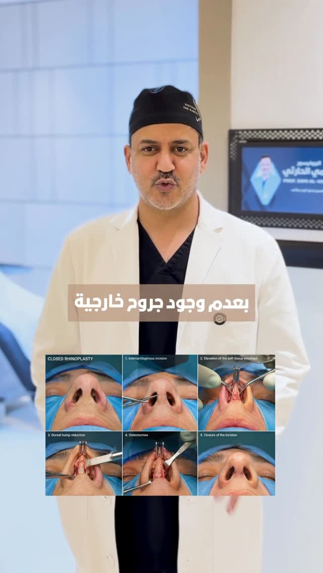 بأيش تتميز العملية المغلقة👃🏻⁉️#سامي_الحارثي #تجميل_الأنف #اكسبلور #الرياض by @drsalharthi